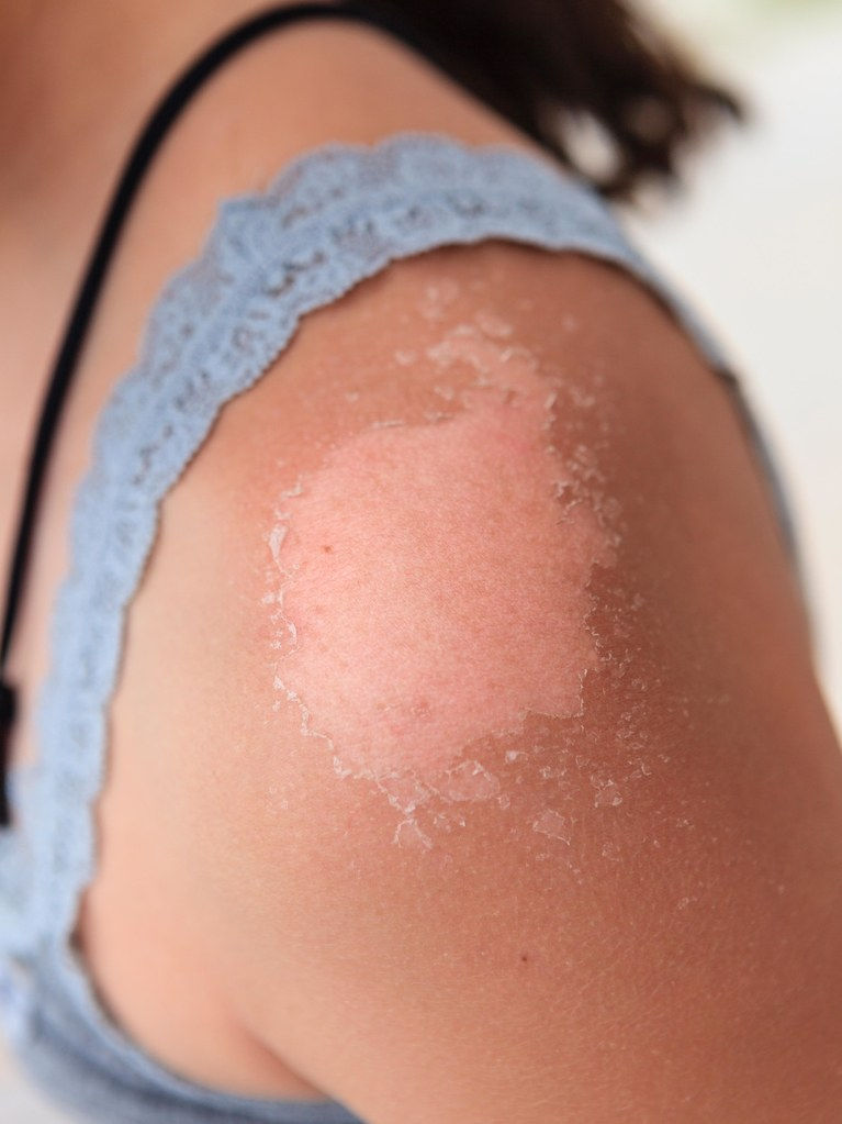 Varför din hud skalar efter en solbränna, enligt hudläkare