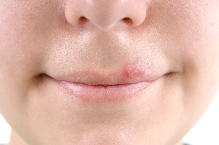 Foto of a person with a cold sore from herpes simplex virus 1