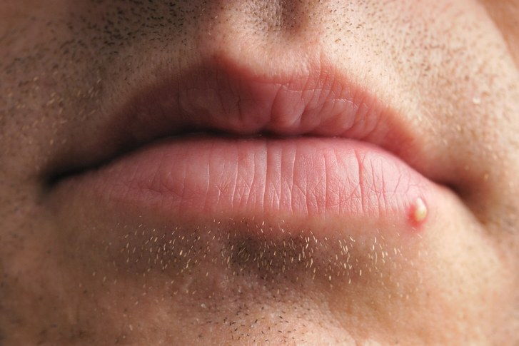 Finne or zit on the lips on the lip area of a person.