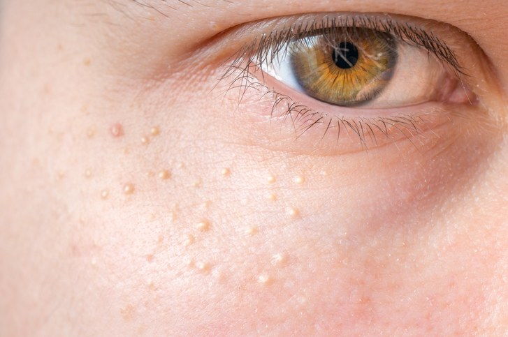Milia (Milium) - pimples around eye on skin