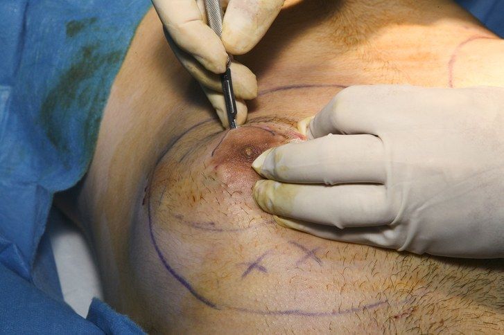 Muž patient undergoing breast reduction surgery