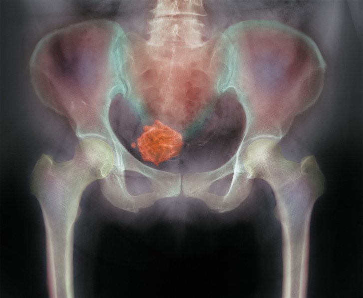 maternicovej fibroid X-ray image