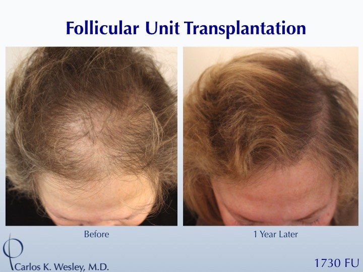 vlasy follicle transplant before after