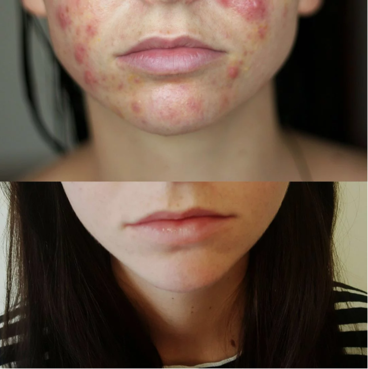 bloggare alice lang before and after acne photos 