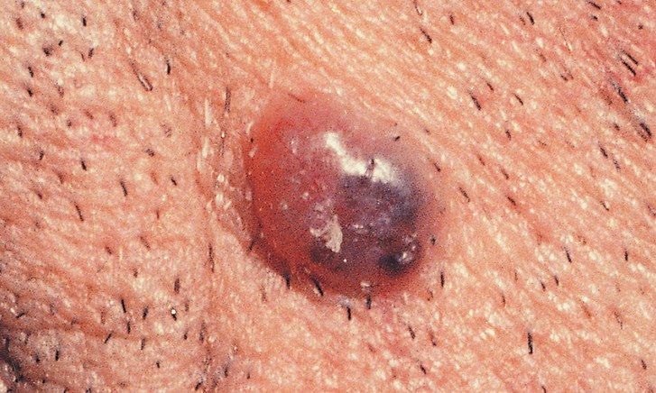 základné Cell Carcinoma skin cancer