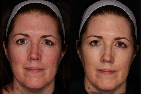 laser before after treatment redness