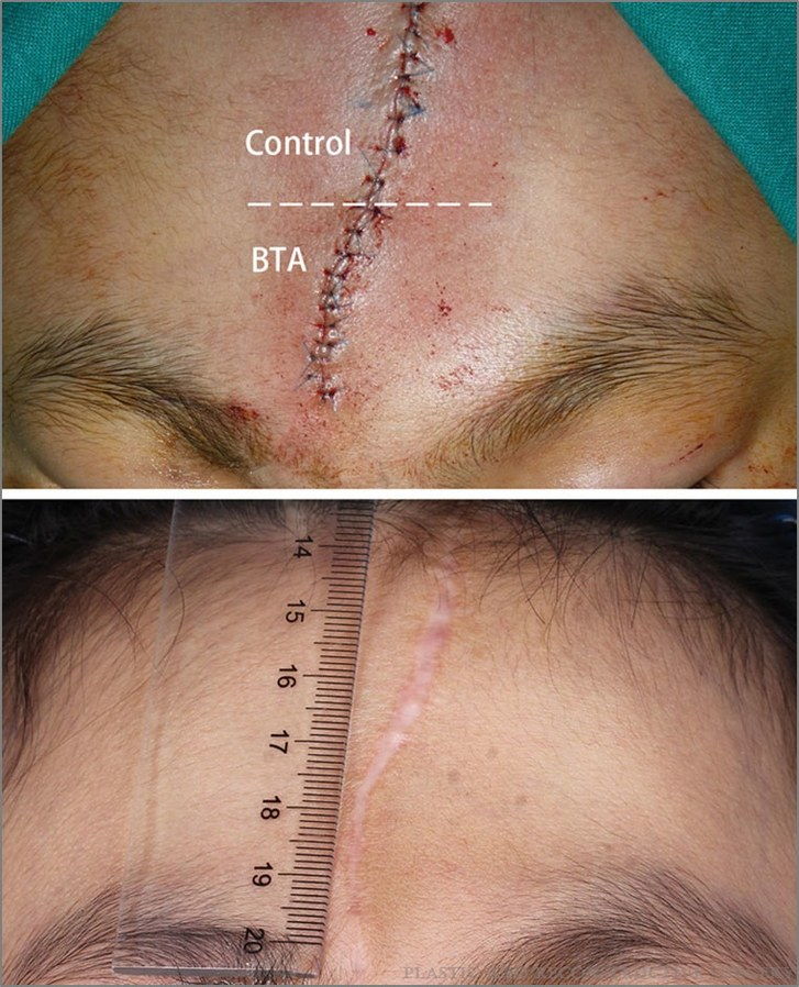 pred and after image of patient with Botox injections in facial scar
