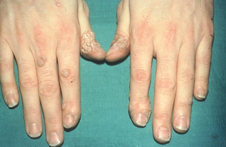 jednotlivec with common warts on fingers and thumbs
