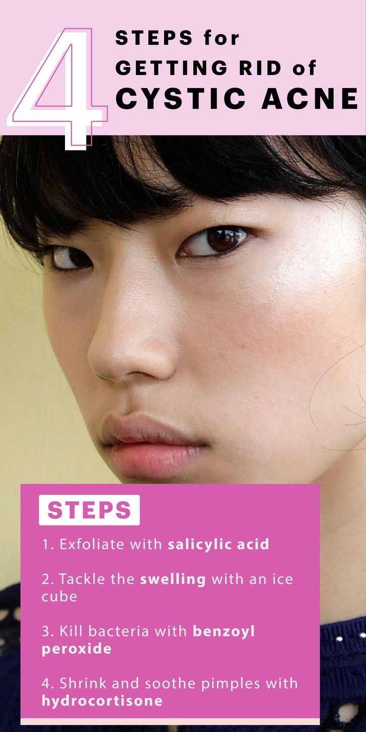 cistično acne guide