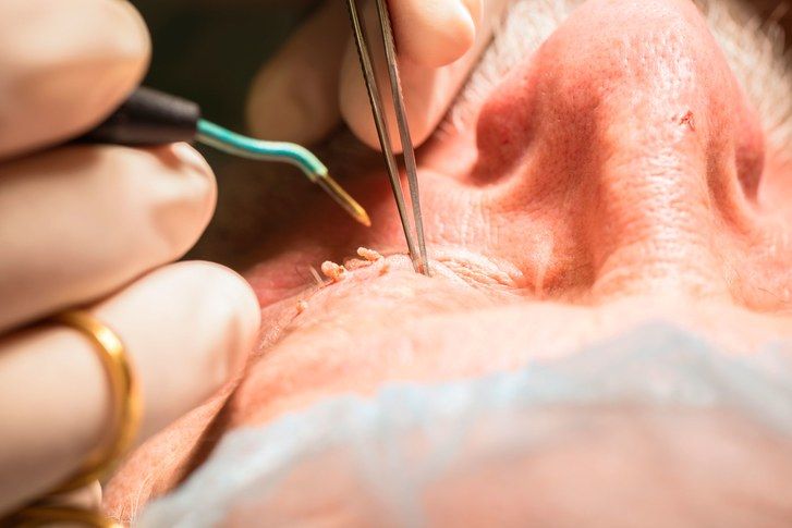 Läkare removing man's filiform warts from eyelid