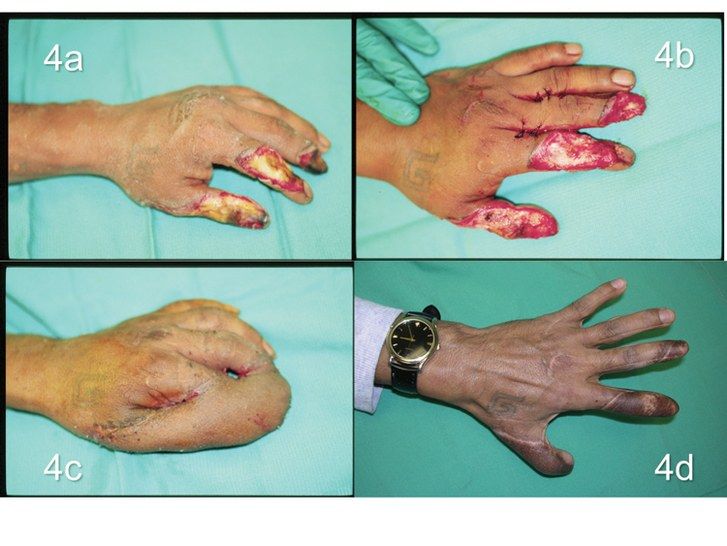 fotografie of man with fourth-degree burns on hand