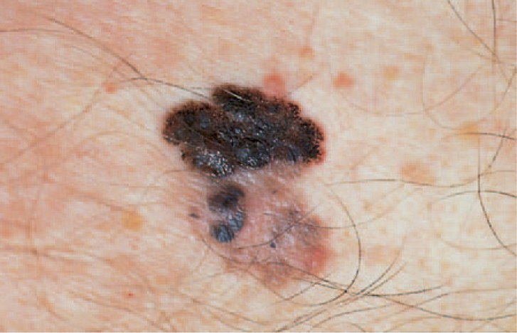 Melanom skin cancer
