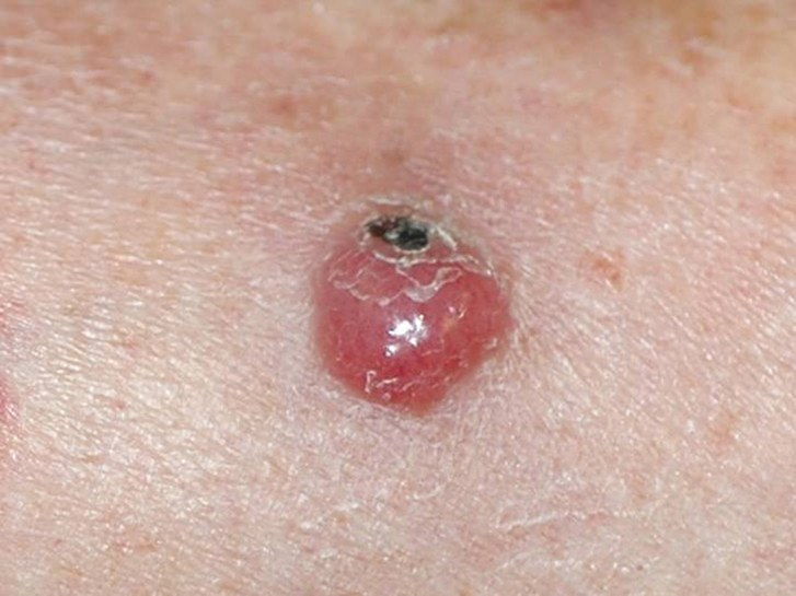 Меркел cell carcinoma skin cancer
