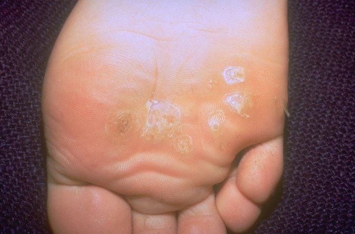 Enskild's foot with plantar warts