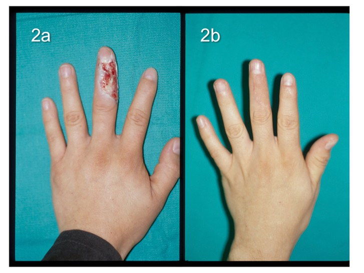 fotografie of hands with second-degree burns