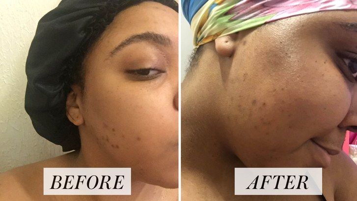 Shammara Lawrence hyperpigmentation before and after photos