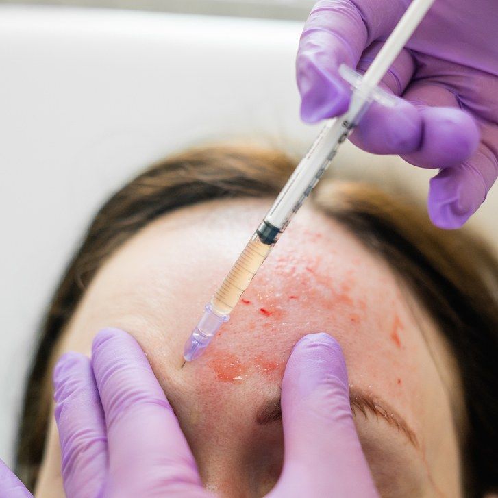 Femeie getting platelet rich plasma (PRP) injected into forehead