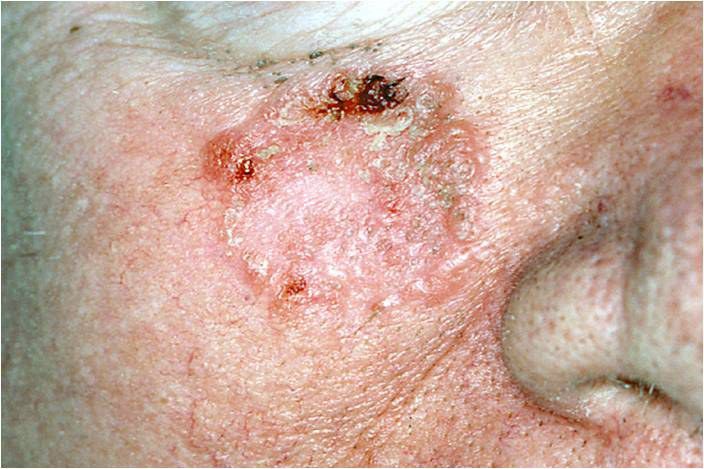 dlaždicového cell carcinoma skin cancer