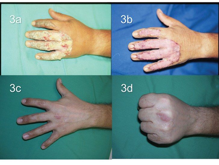 fotografie of third-degree burns on hands