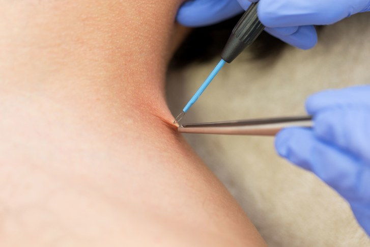 lekár removing wart from individual's shoulder with electric tool